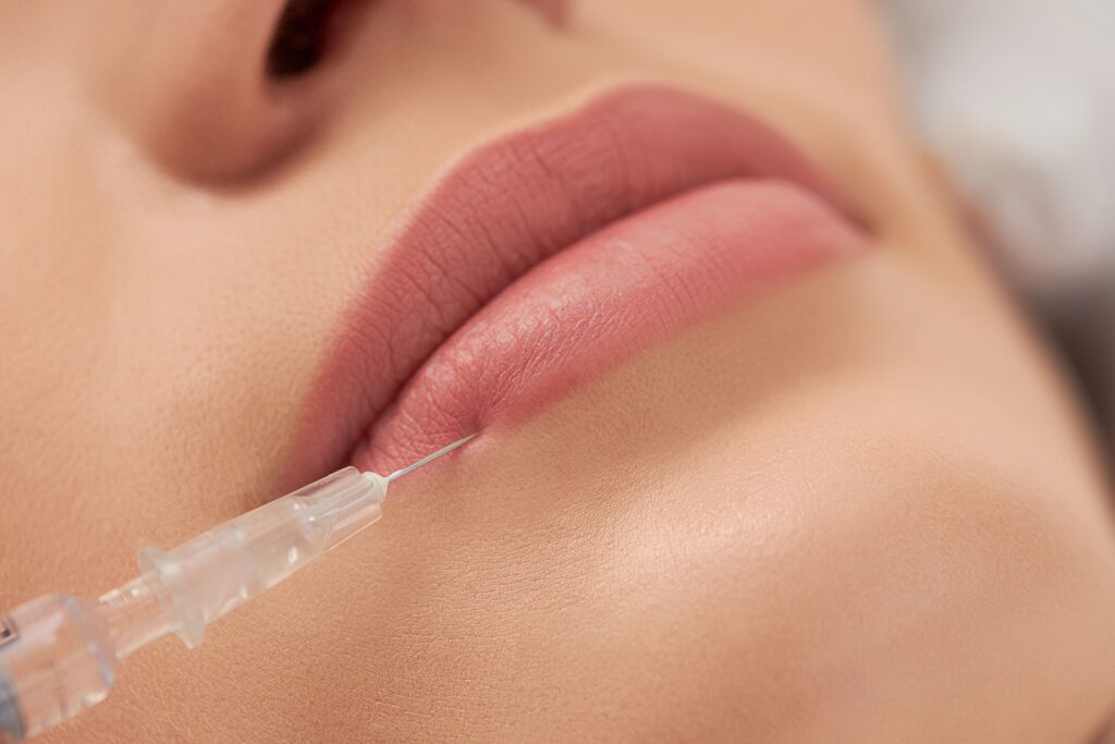 Anvisa alerta para riscos de preenchimento com ácido hialurônico e PMMA em estética segura