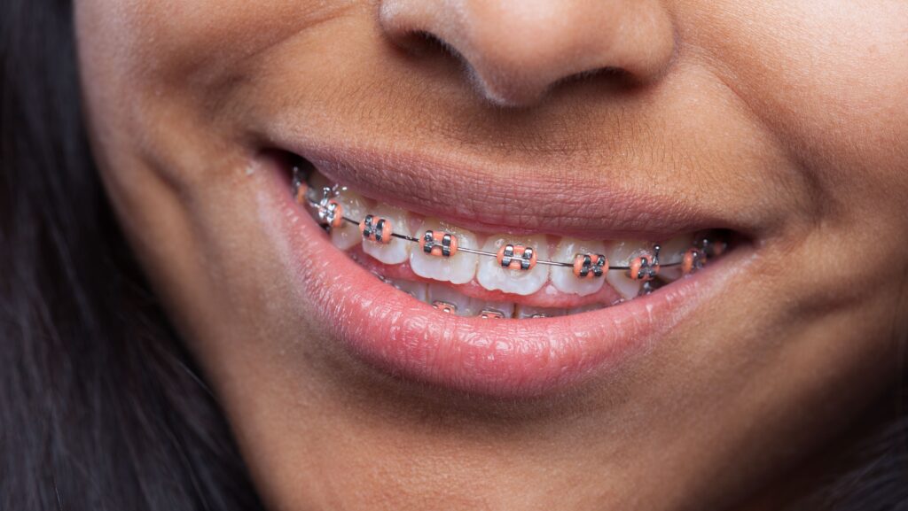 Por que o dente entorta após usar aparelho? Dicas para evitar